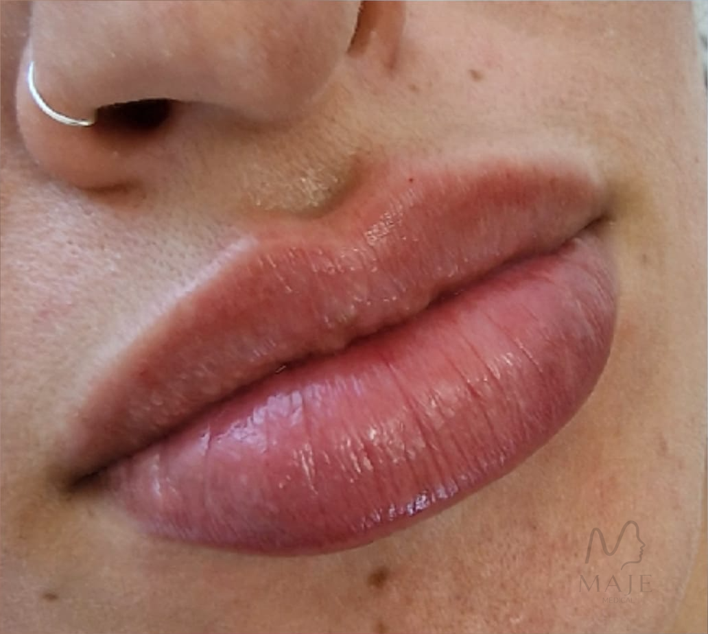 Aumento y perfilado de labios — Maje Medical